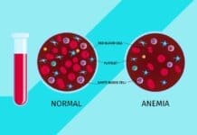 need to know about iron deficiency anemia